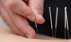 acupuncture