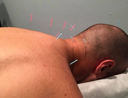 Acupuncture Treatment For Headaches