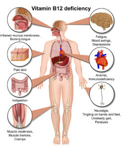 B12 deficiency diagram