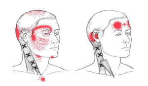 musculoskeletal headache examples