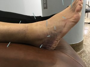 acupuncture on ankle